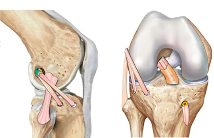 Schema ACL-ALL-Rekonstruktion: Verlauf des vorderen Kreuzbands und des anterolateralen Bandes im Kniegelenk
